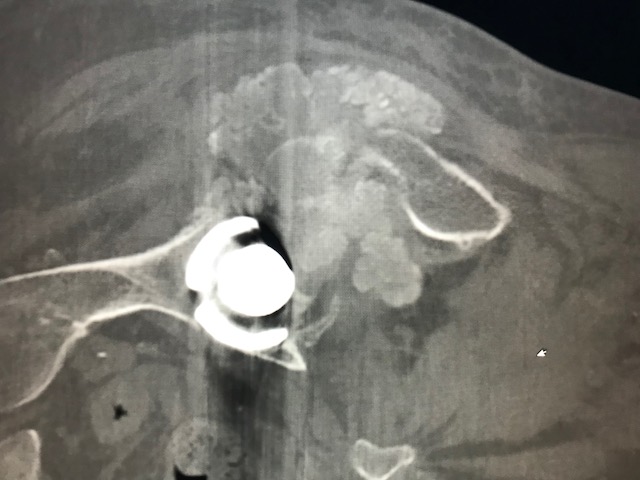 Figure 4 for case Tumoral calcinosis ( RID5202 )
